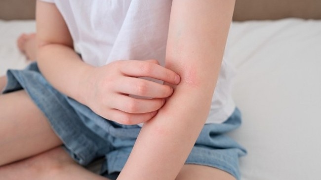 Çocuklarda 'Alerjik Hastalıklar' Hakkında Doğru Sanılan 8 Hatalı Bilgi!